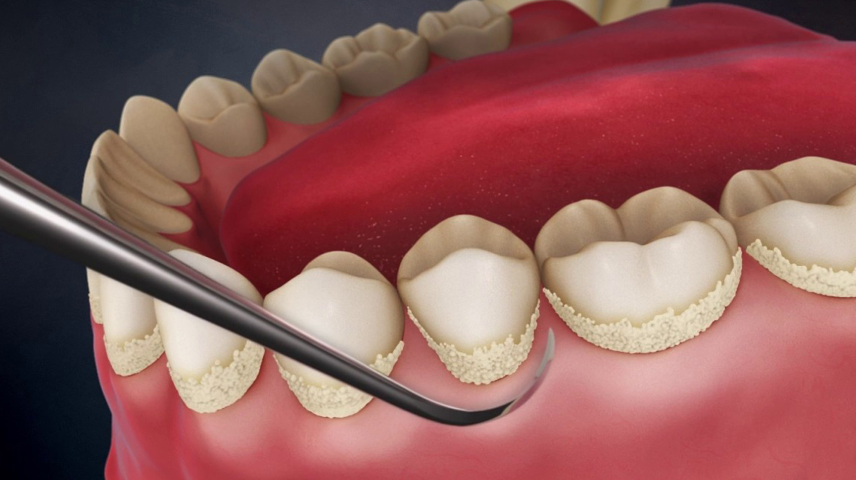 Сколько стоит снимать зуб. Зубной камень наддесневые отложения. Неминерализованные зубные отложения.