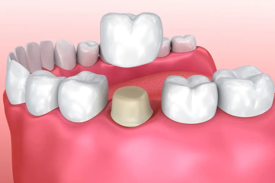 DentalCrown900x600 https://anewyoutravel.com/wp-content/uploads/2025/11/DentalCrown900x600.jpg