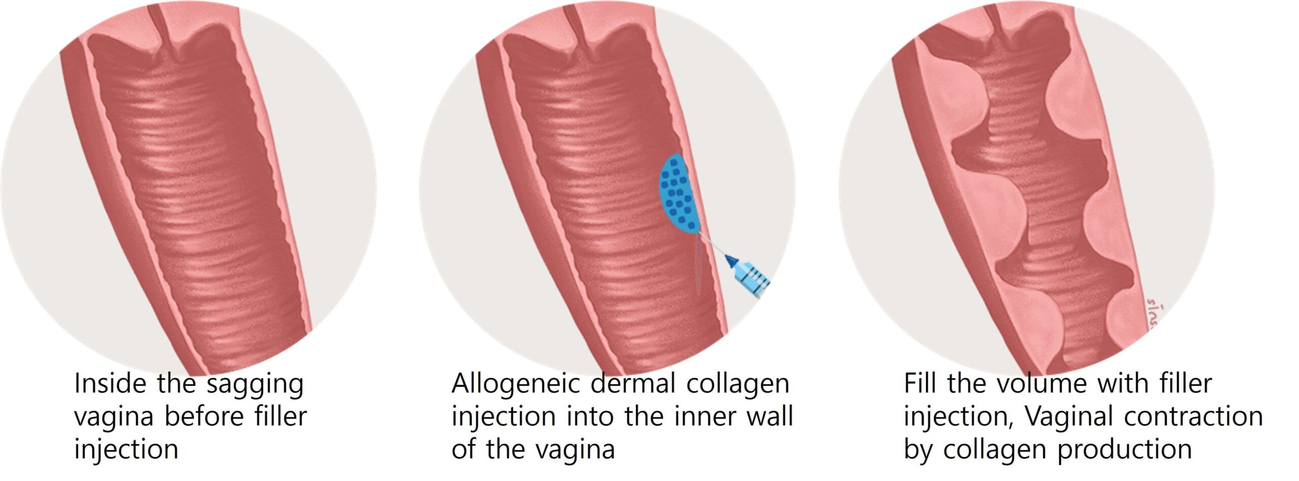 https://anewyoutravel.com/wp-content/uploads/2025/11/Vaginal_fillers-scaled.jpg