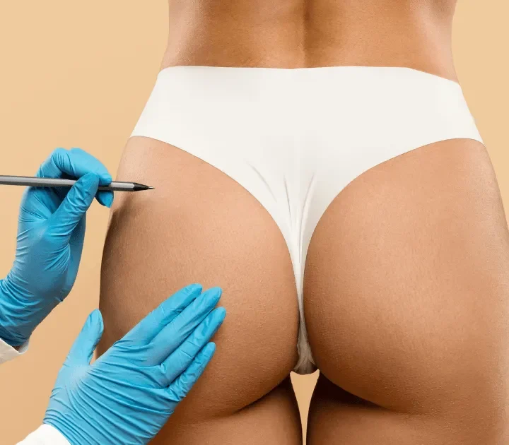 Brazilian Butt Lift (BBL) in Istanbul Brazilian Butt Lift (BBL) in Istanbul