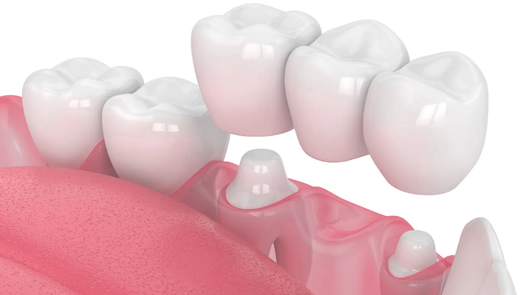 dental-bridges https://anewyoutravel.com/wp-content/uploads/2025/11/dental-bridges.webp