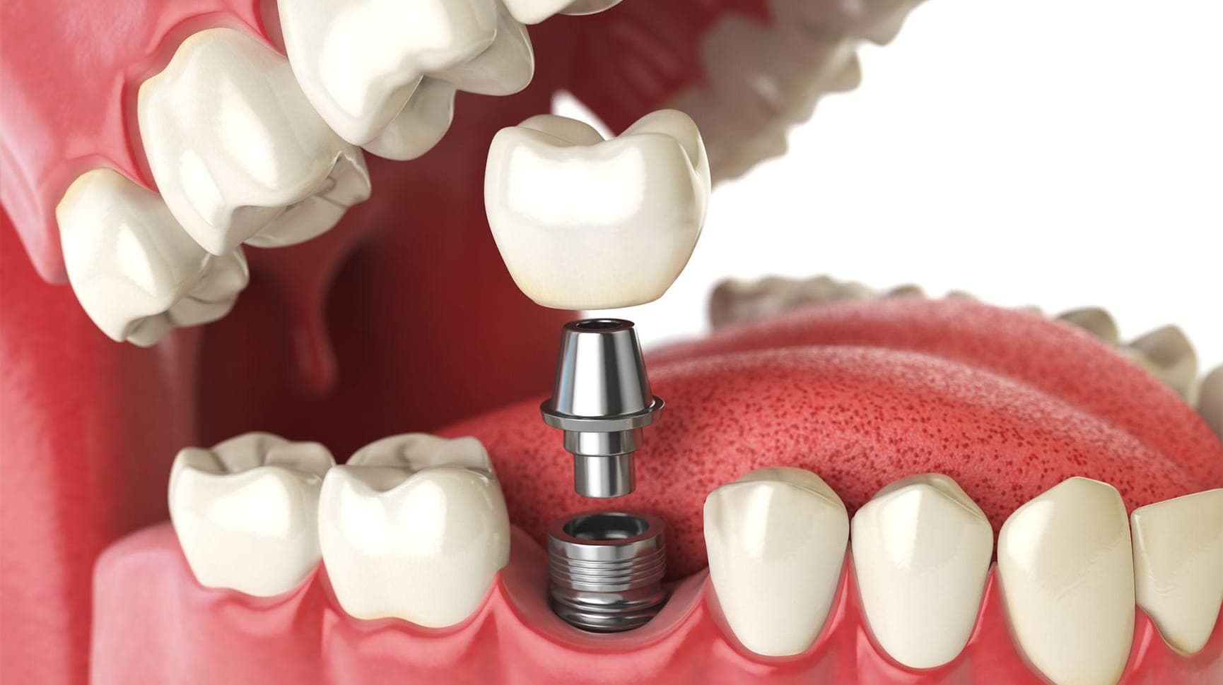 dental-implant https://anewyoutravel.com/wp-content/uploads/2025/11/dental-implant.jpg