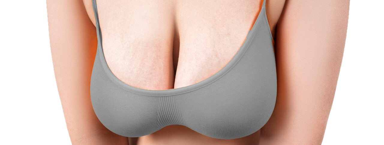 Postpartum Breast Sagging