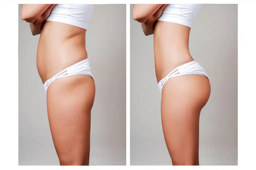 Why Are Combined Body Contouring Surgeries So Popular?
