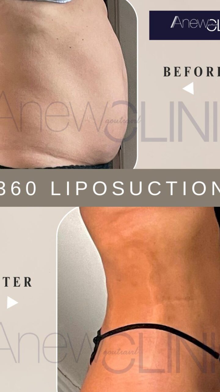 360 Liposuction in Turkey: Safe, Sculpted Results in Istanbul’s JCI-Accredited Hospital