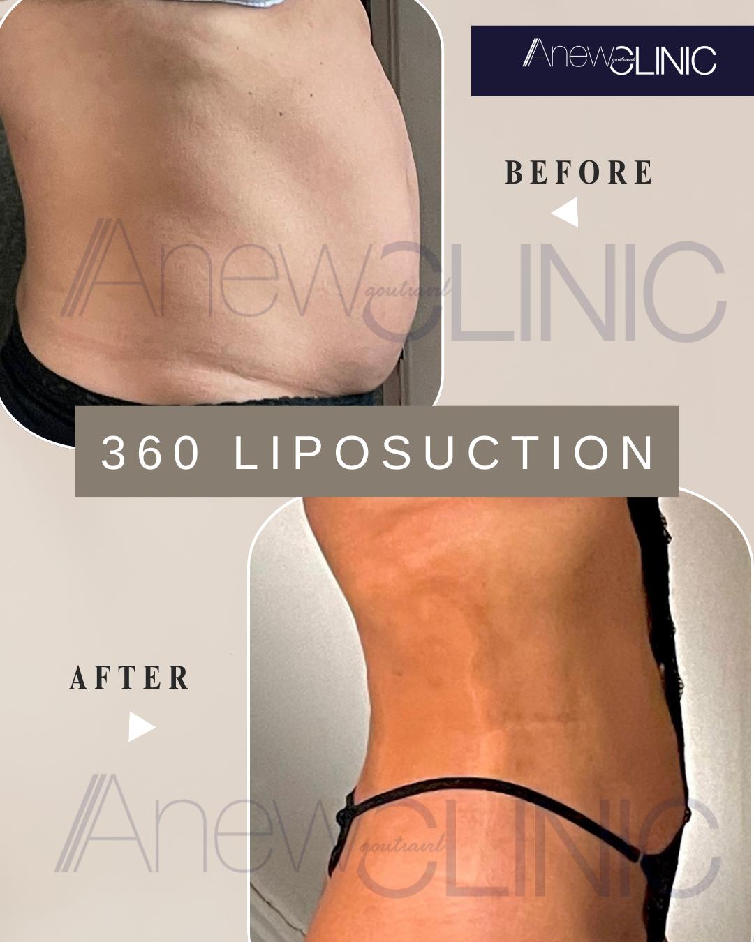 360 Liposuction in Turkey: Safe, Sculpted Results in Istanbul’s JCI-Accredited Hospital