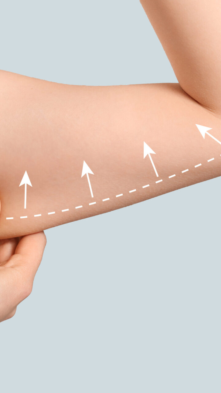 Arm Lift in Turkey: Complete Guide to Brachioplasty in Istanbul