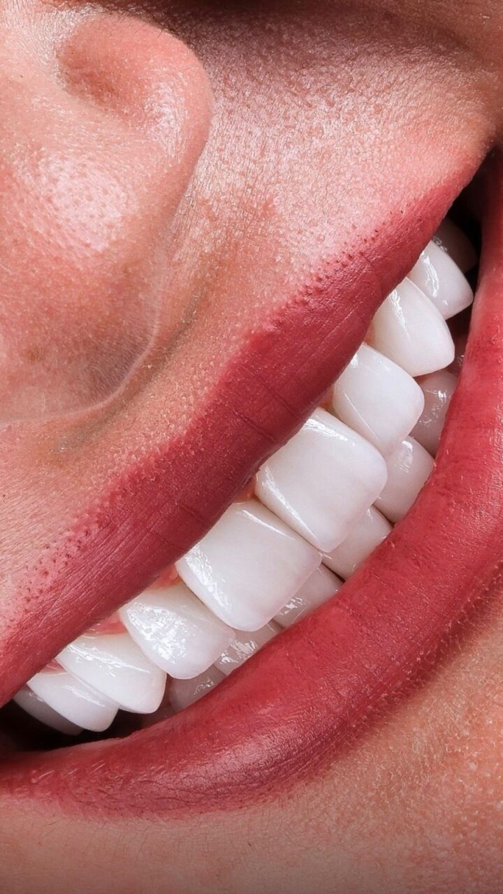 Hollywood Smile in Turkey: Achieve a Perfect Smile Effortlessly with Anew Clinic