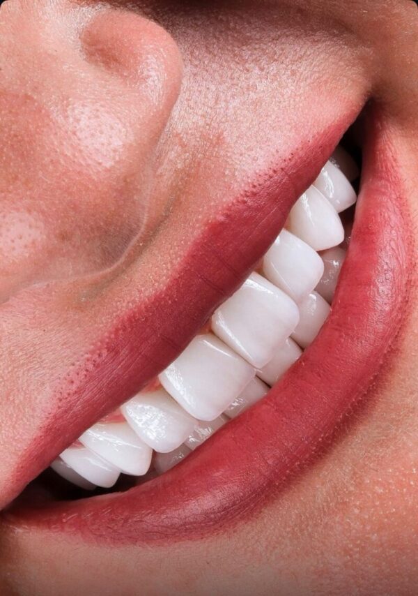 Hollywood Smile in Turkey: Achieve a Perfect Smile Effortlessly with Anew Clinic