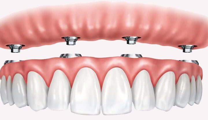 Hybrid Dental Implants: A Modern Solution for Full Smile Restoration