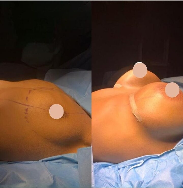 Breast Implants (Breast Augmentation): Everything You Need to Know