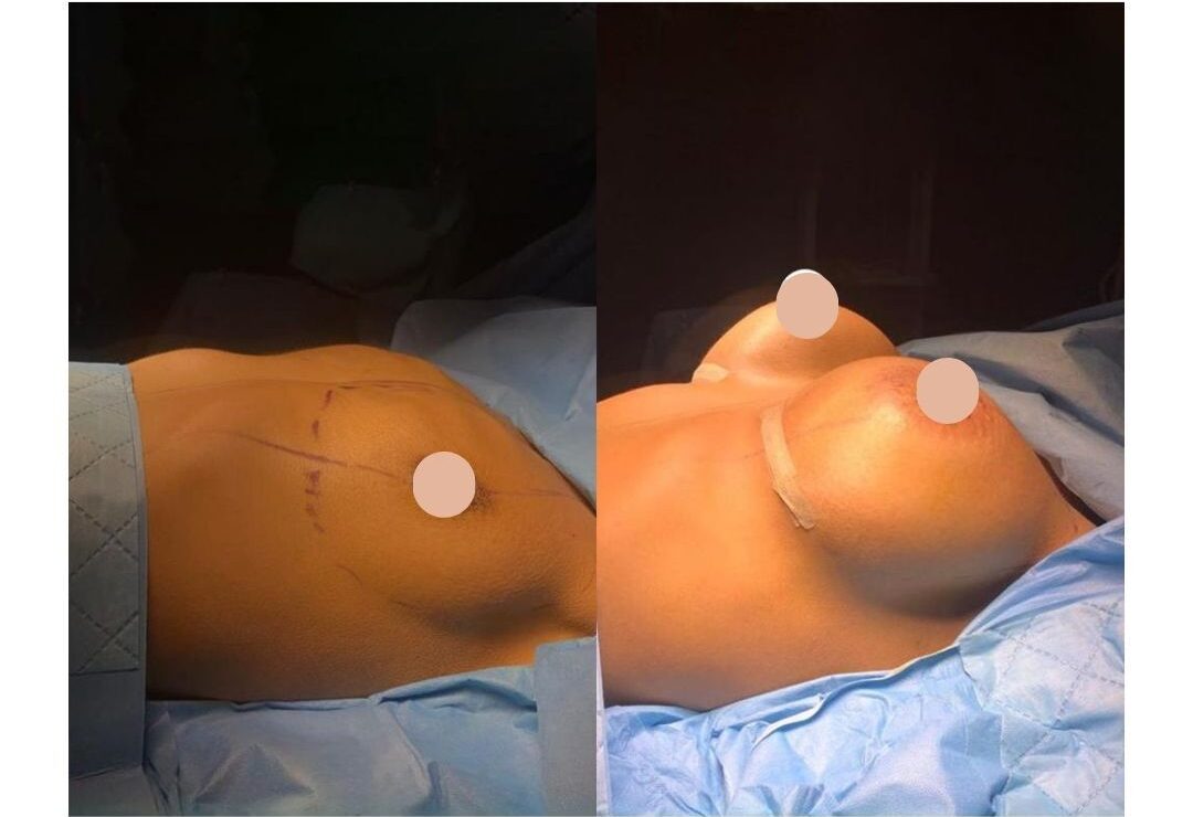Breast Implants (Breast Augmentation): Everything You Need to Know