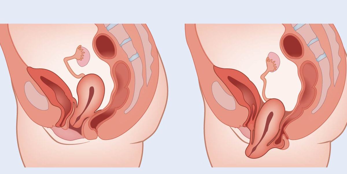 Vaginal Prolapse: Symptoms, Causes, Diagnosis and Treatment Options